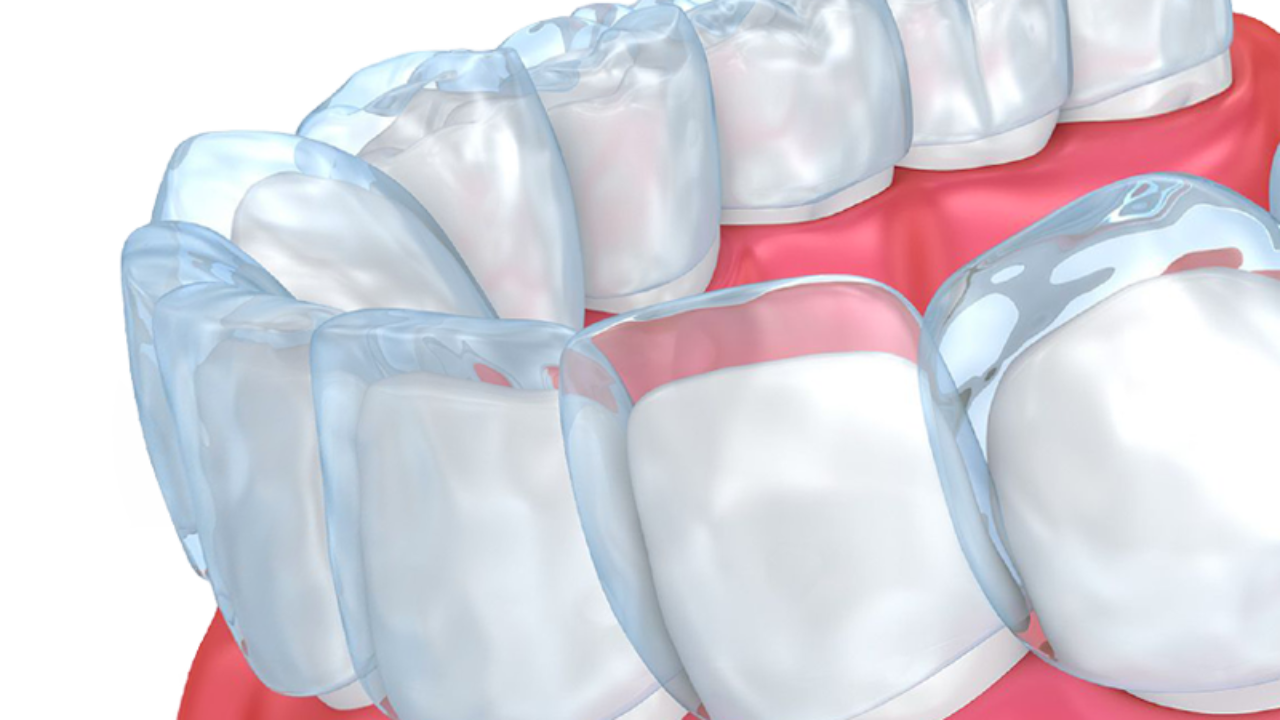 How to Clean and Maintain Invisalign Trays - Stoneycreek Village Dental
